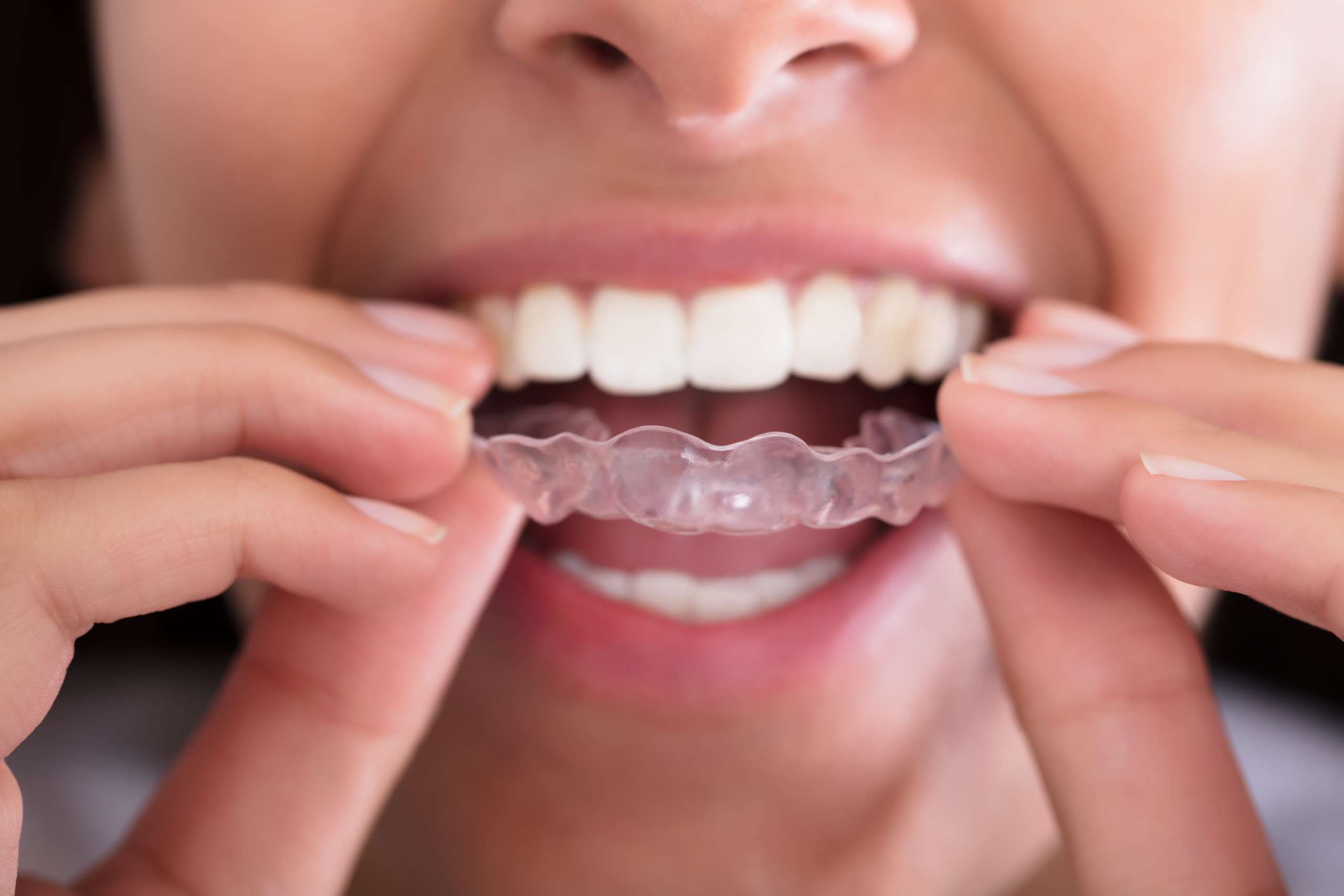 alinhador transparente – Kaizen Odontologia